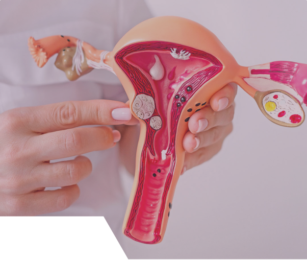 Tipos de endometriose