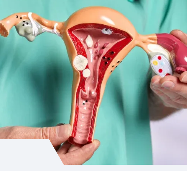 Tratamento para endometriose em Uberlândia